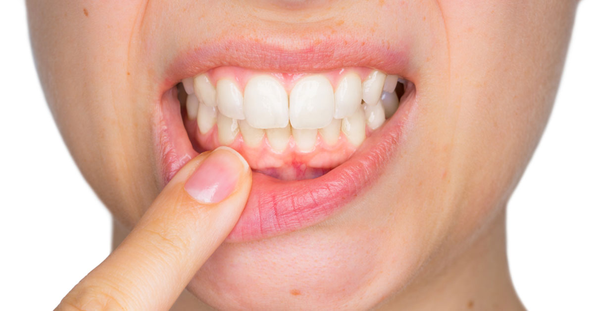 Close up of woman’s mouth, showing teeth, with finger pointing to gums