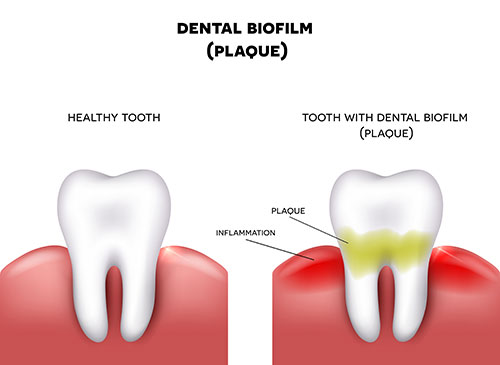 Illustration of health tooth vs. tooth with plaque