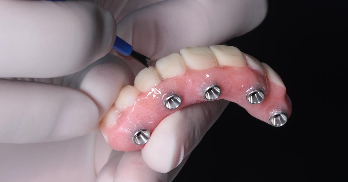 Dentist cleaning and inspecting All-on-4 dental implants before placement