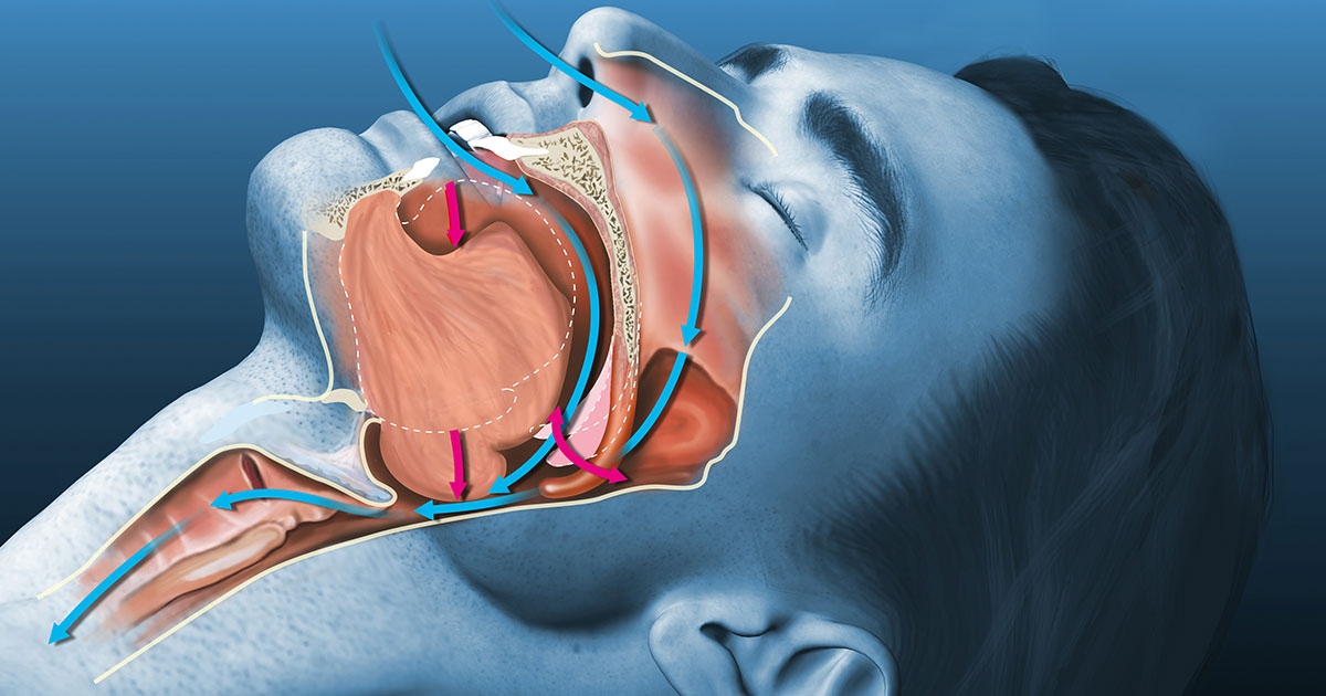 Diagram of obstructive sleep apnea