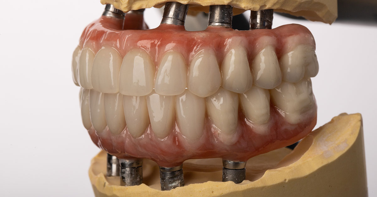 Dental model of all-on-4 implants