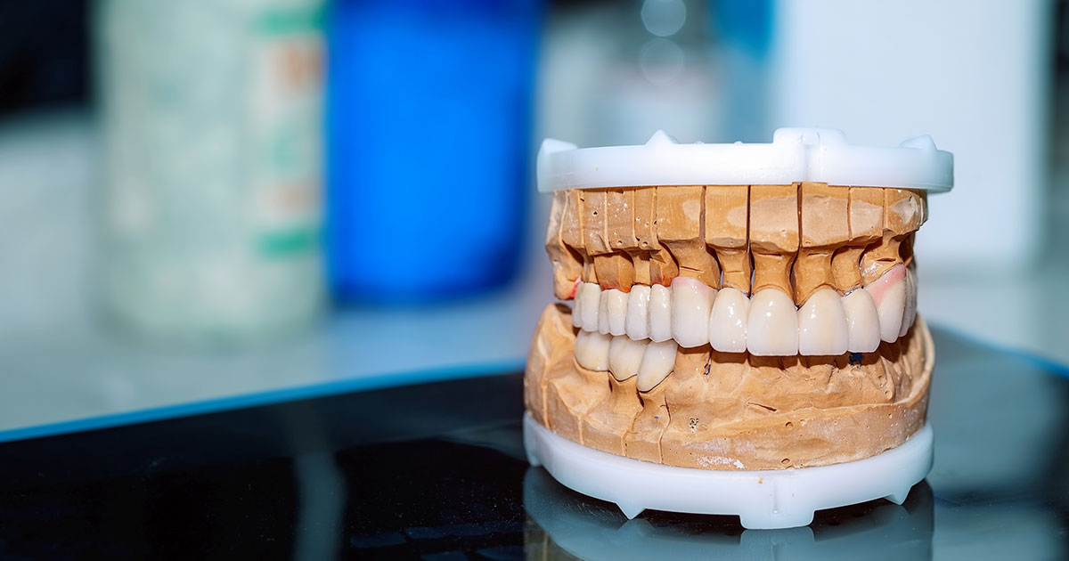 Model of a dental restoration