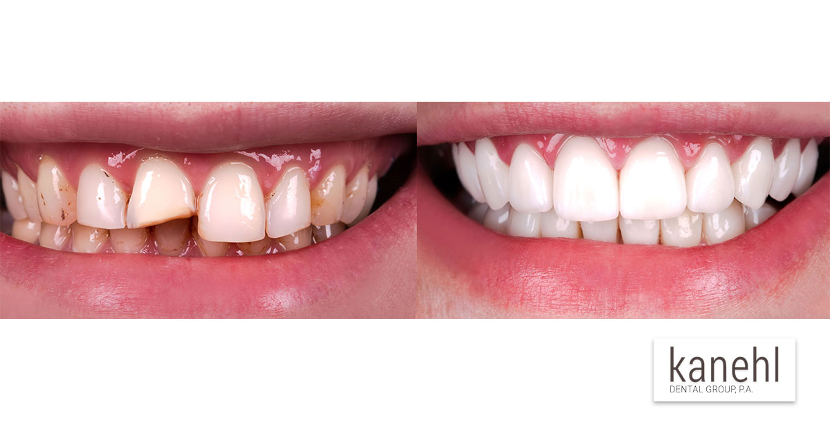 calor despreciar disparar 8 Most Common Types of Dental Restoration | Kanehl Dental