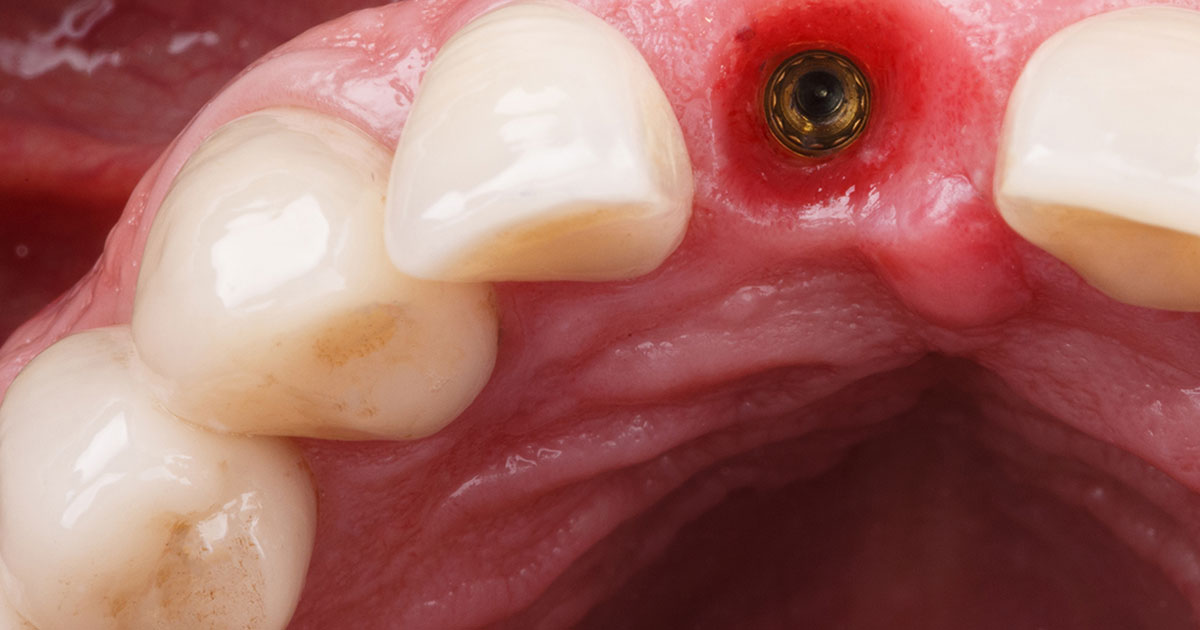 Close-up photograph of the inside of a person’s mouth, showing gum inflammation around a titanium implant stud.