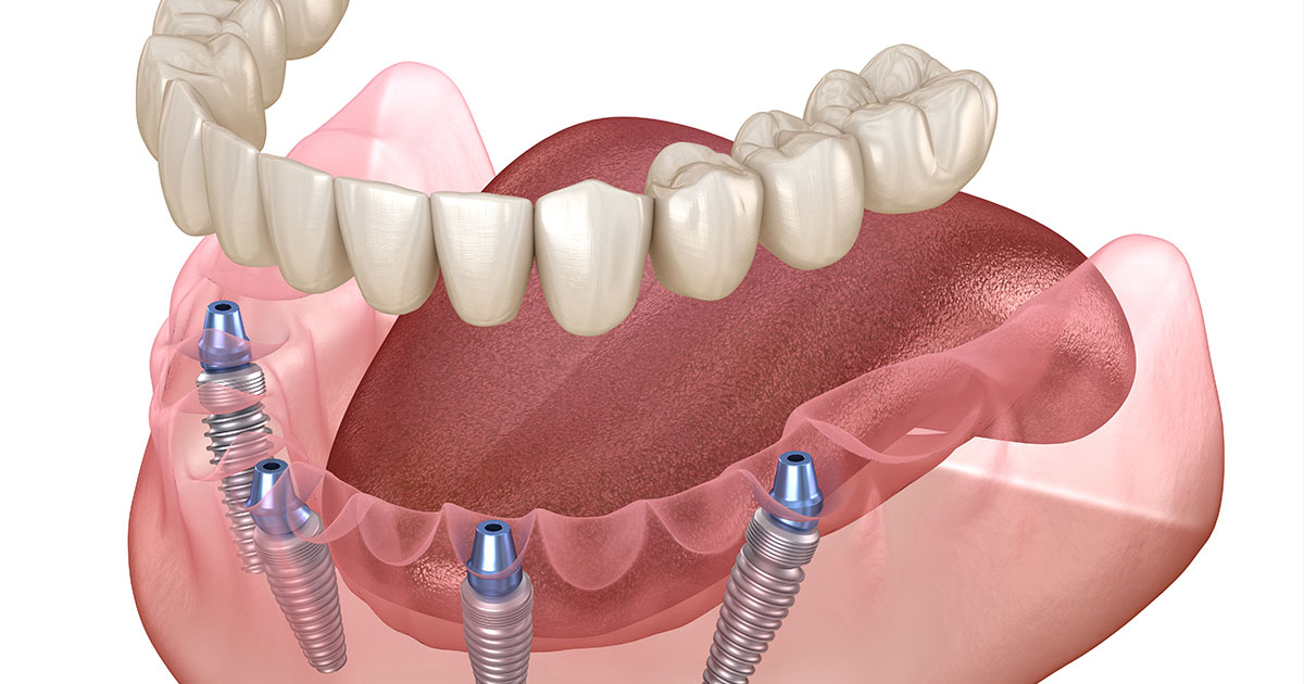 Illustrated diagram of All-On-4 dental implants screwed into the bottom gums, showing their hardware and the prosthetic teeth to be attached.