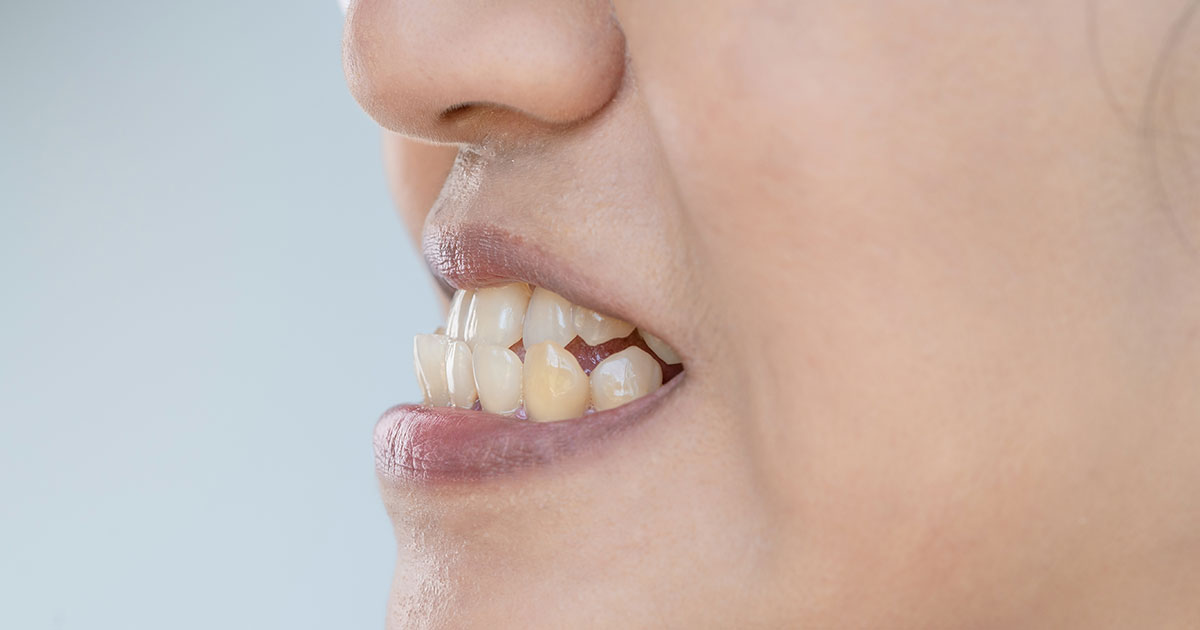 A closeup of a person with an underbite due to malocclusion showing their teeth.